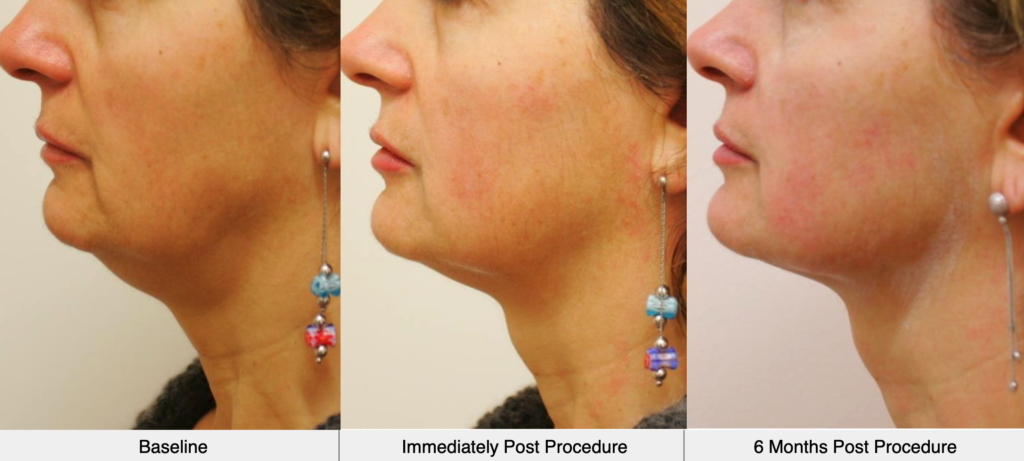 before-after-ultraformer-3-chin-results