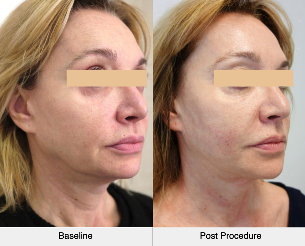 before-after-ultraformer-3-face-side-results