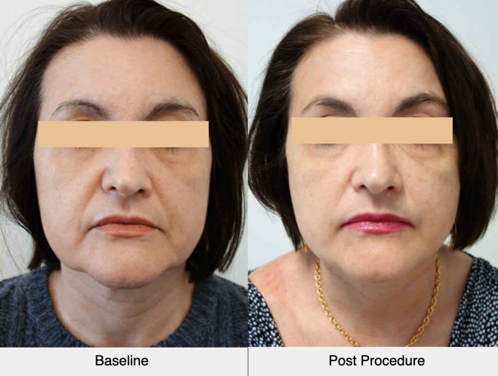 before-after-ultraformer-3-face-front-results
