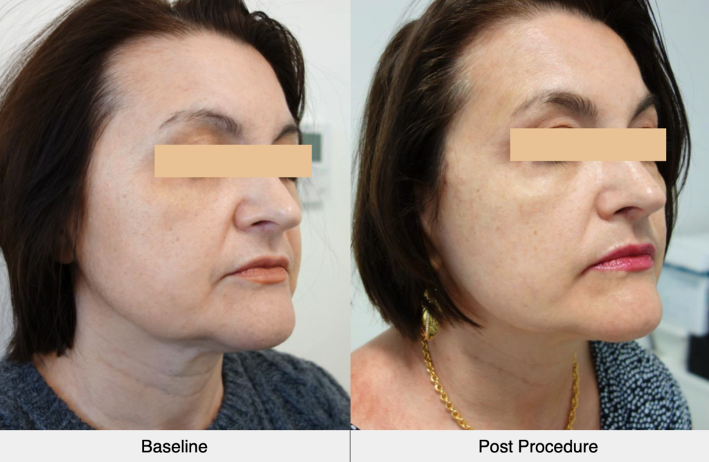 before-after-ultraformer-3-face-results